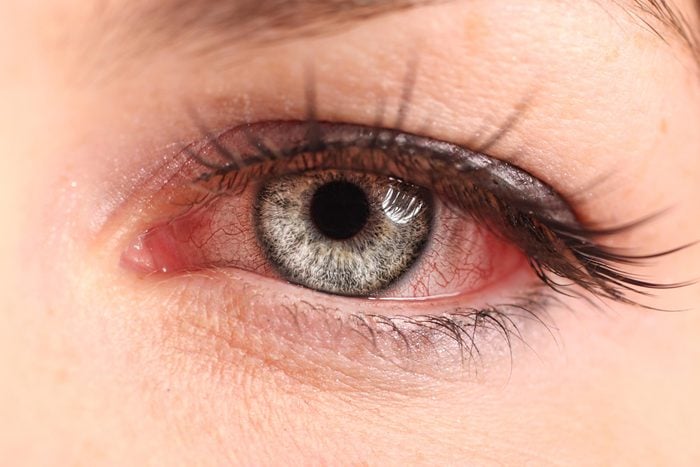 7 Pink Eye Symptoms You Shouldn't Ignore