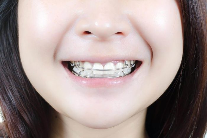 Smiling girl with a retainer her mouth.