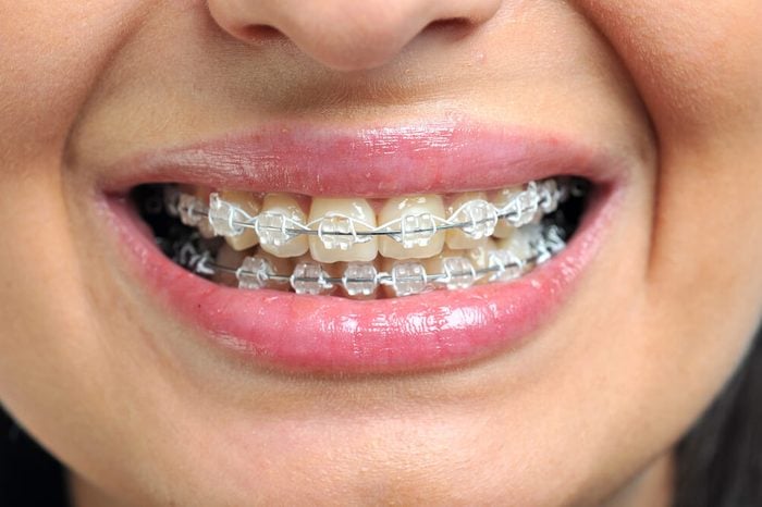 Ceramic and metallic braces on a woman's teeth.