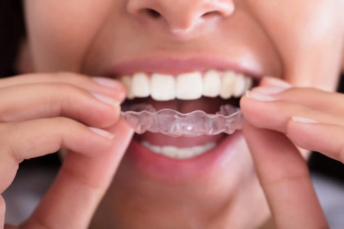 Woman putting a transparent aligner like Invisalign in her mouth.