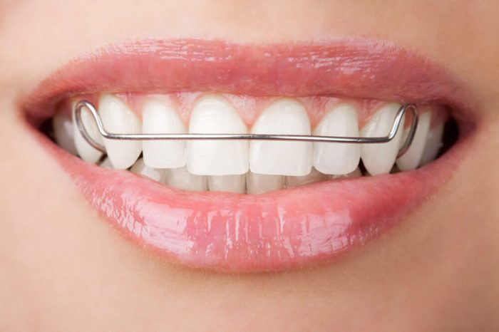 Woman's teeth with retainer.