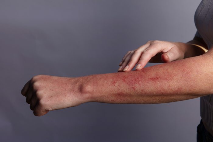 close up of rash on arm