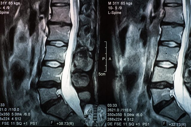 MRI of human spine with a disc herniation.
