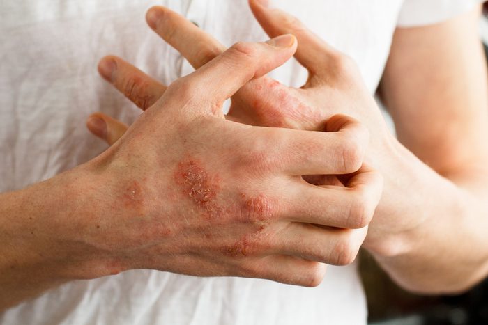 eczema on hand