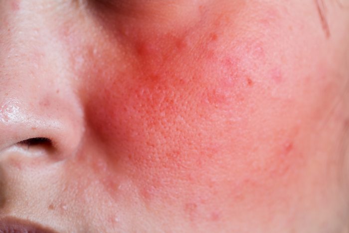 Face of a young woman with rash from an allergic reaction to cosmetics, closeup.
