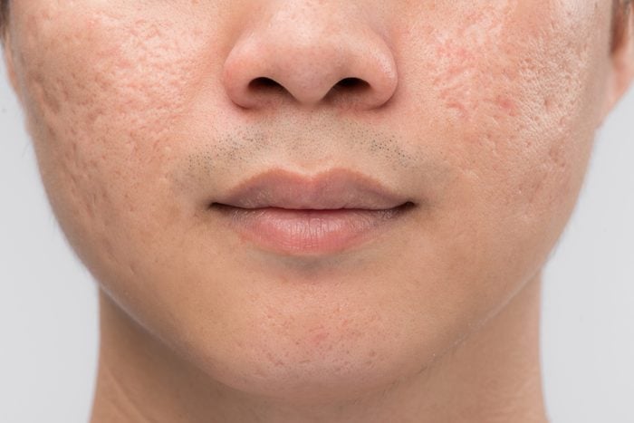 Man with oily skin and acne scars isolated on white background