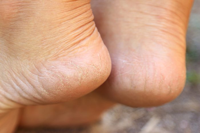 Cracked heel on woman's foot