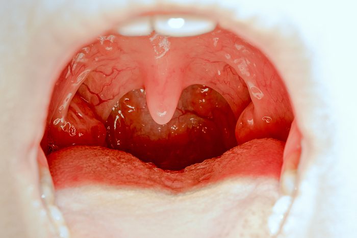 Closeup view of open mouth with tonsils and uvula