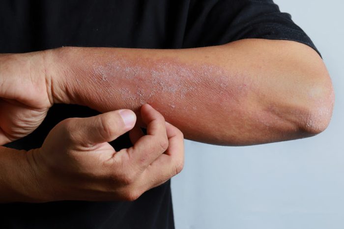 Man scratching an allergic rash on the skin of his arm.