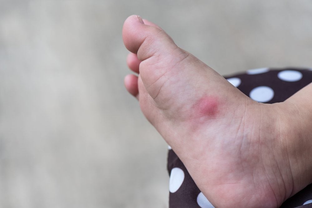 tick rash on foot