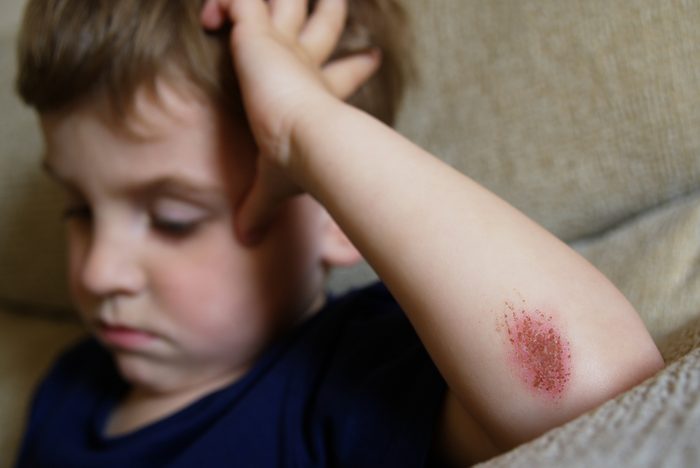 boy with scraped elbow