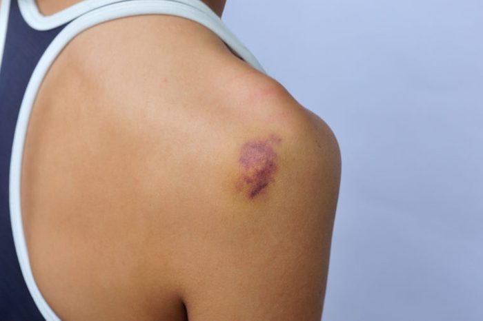bruise and injury on female shoulder 