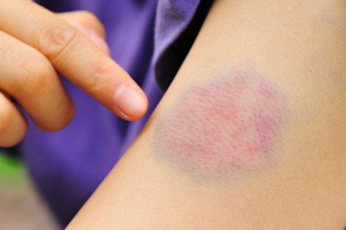 a person pointing to a bruise on their arm