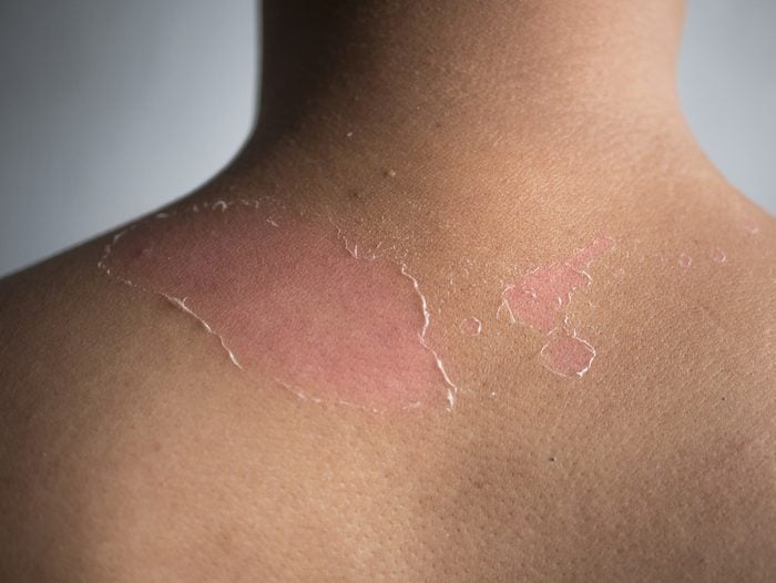 peeling skin at back and shoulder from sunburn