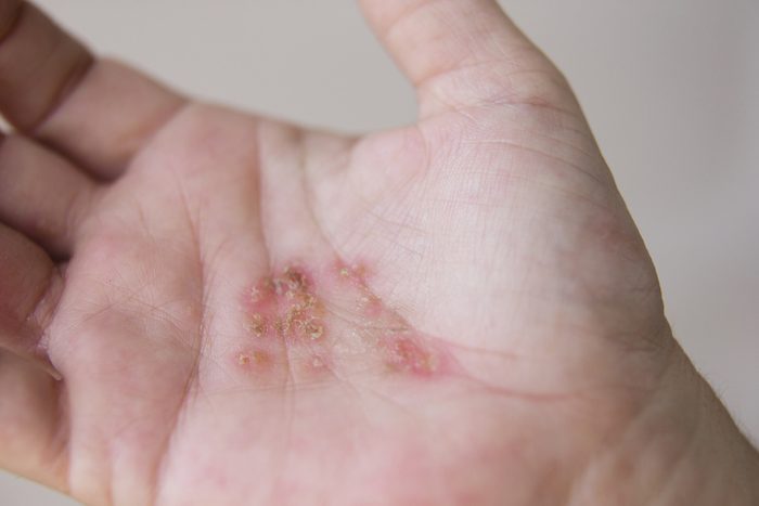 Hands of an adult woman with contact dermatitis