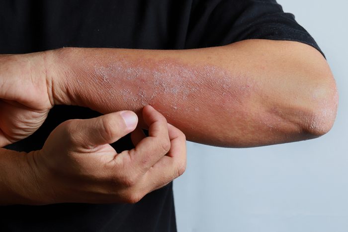 man scratching eczema on his arm