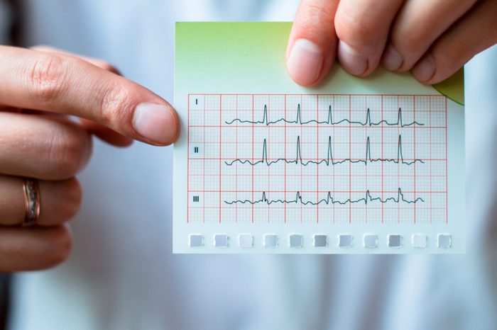 Electrocardiogram, ecg in hand, palm of a doctor. 