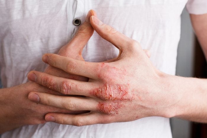 psoriasis or eczema on hand