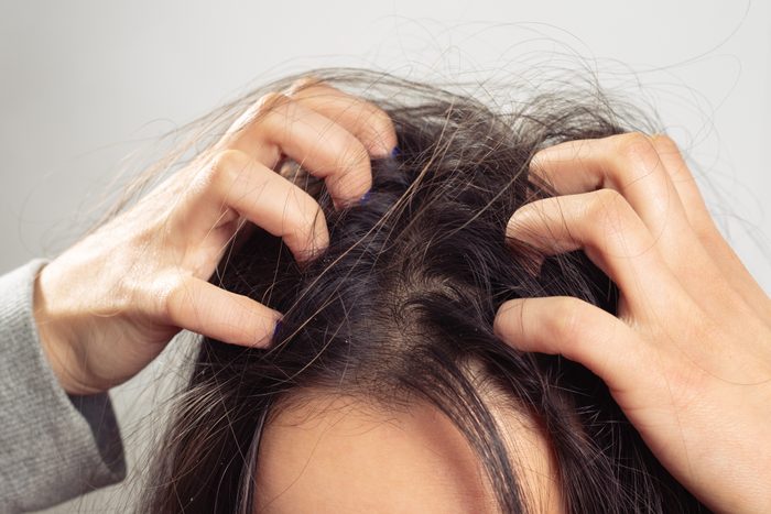 close up of woman scratching scalp with dandruff