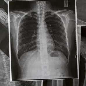 12 Silent Signs Your Lungs Could Be in Trouble