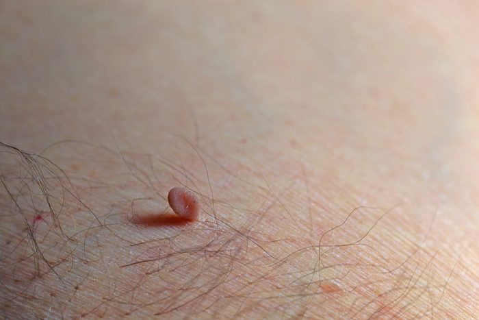 Large brown skin tag attached to the hairy armpit of a man held on by a small section of the tag. Selective focus with space for text.