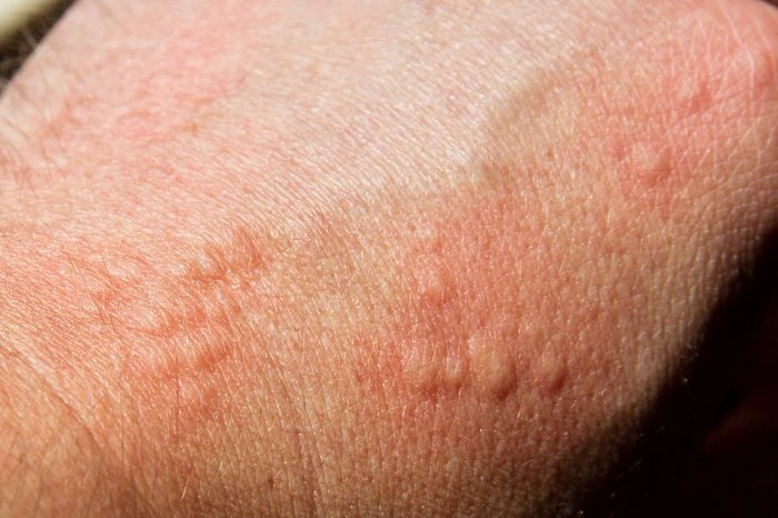 rash on an arm
