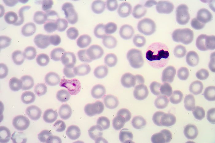 Malaria. Normal and infected red blood cells. Malaria is a disease caused by a parasite called Plasmodium that is spread to humans by the bite of an infected mosquito