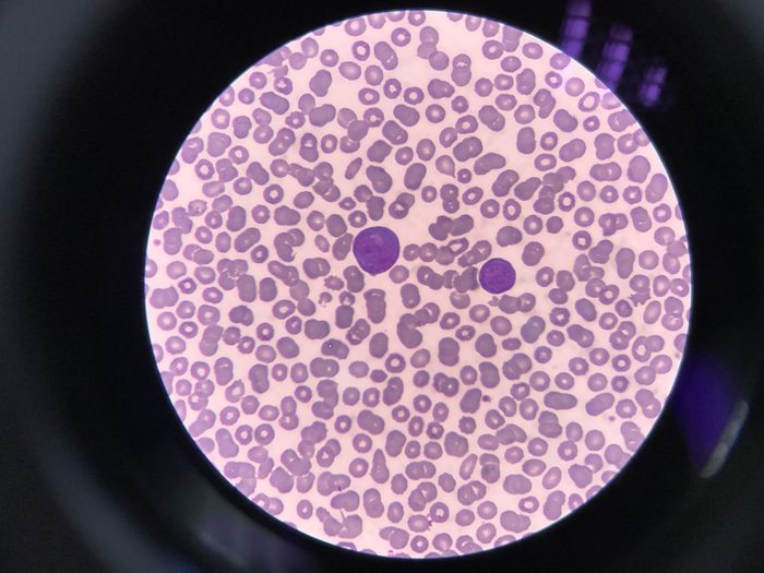 Human blood smear view from microscope. Show Abnormal white blood cell Called Atypical lympphocyte.Found in dengue fever