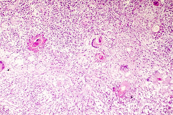 Liquefactive necrosis of the human brain, light photomicrograph showing loss of cell outlines, accumulation of cellular debris, macrophage infiltration. Developes in stroke, necrotising encephalitis