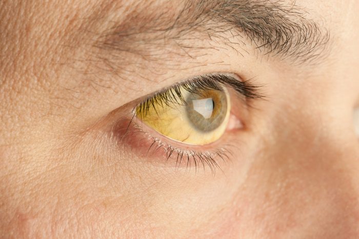 yellow jaundice eyes