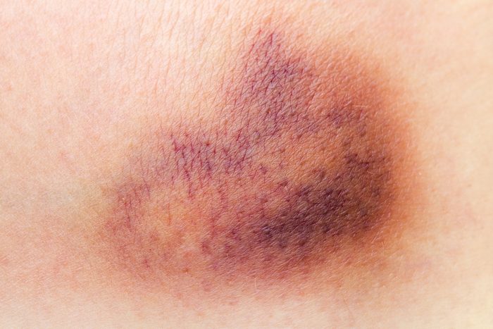 Closeup on a Bruise on wounded woman leg skin