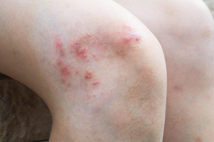 red rash on a knee
