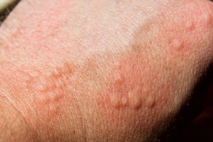 hives from an Allergy