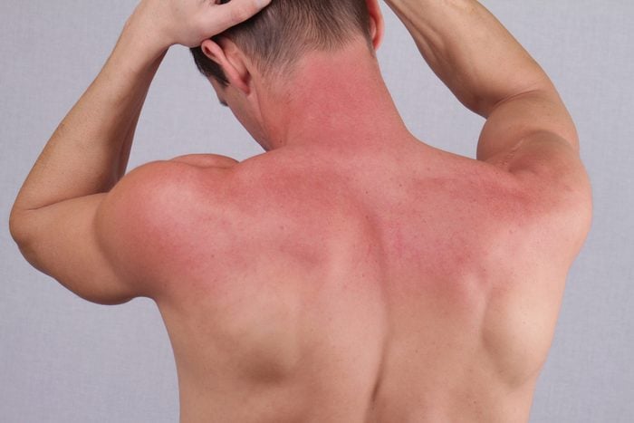 Man with sunburn. Sun skin care