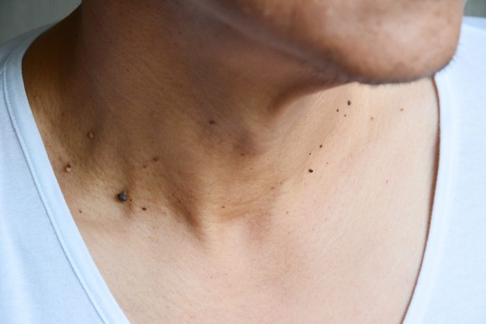 woman with moles on neck