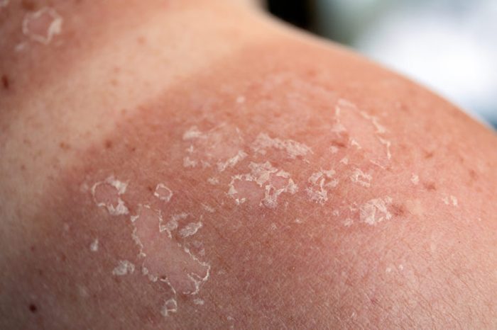 Peeling skin at back and shoulder from a sunburn. 