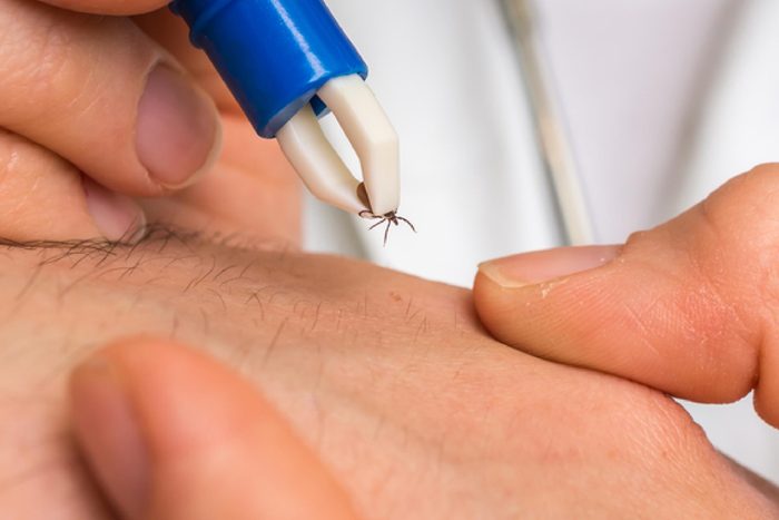 Female doctor removing a tick with tweezers from hand of patient. Encephalitis, borreliosis and lyme disease.