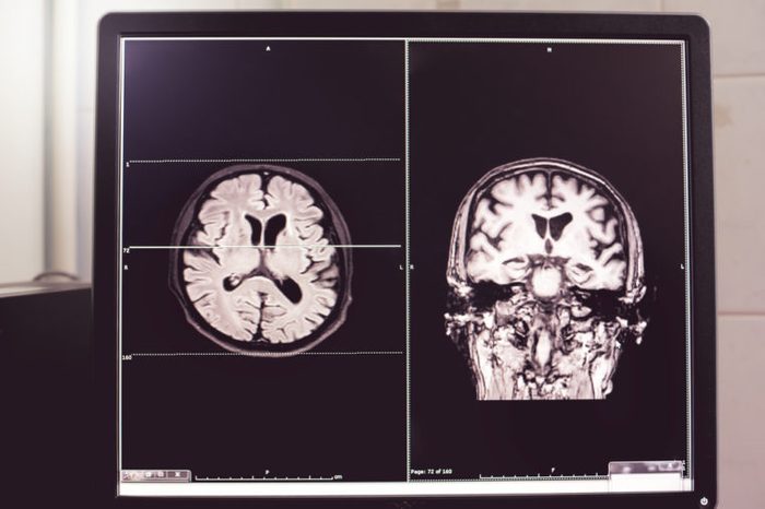 MRI brain scans of Dementia patient 