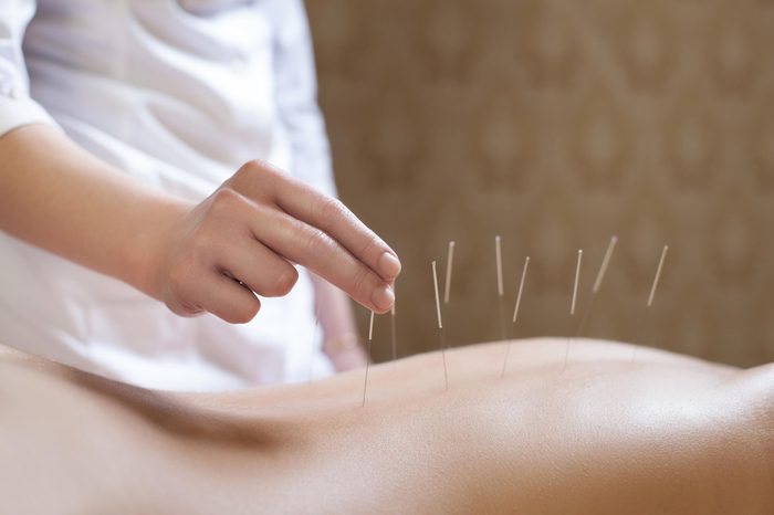 Acupuncturist putting needles in woman's back
