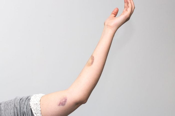 Bruises on woman's arm