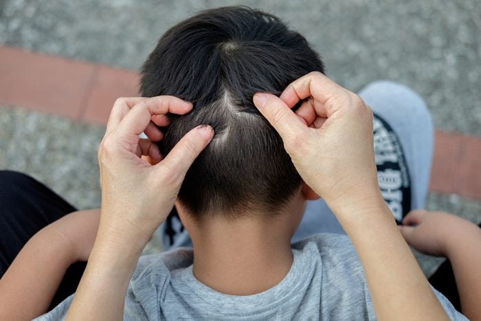Head Lice: Here are 14 Tips and Facts From Lice Experts | The Healthy