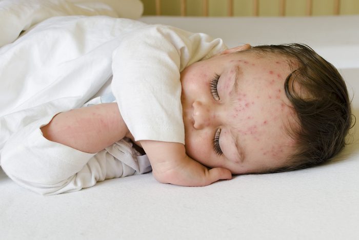 Portrait of a sleeping child with red spots on his skin of chicken pox. 