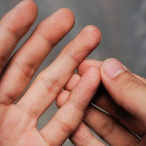 Closeup of Eczema Dermatitis on Back of Fingers.