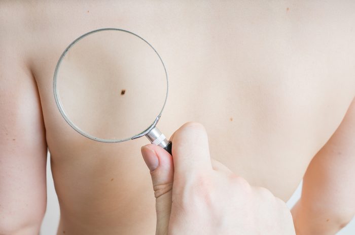 Doctor examine patient skin for melanoma using magnifying glass