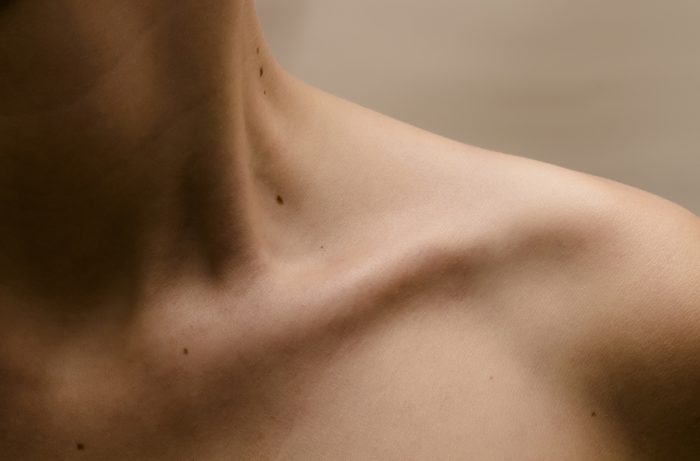 woman's bare shoulder with moles on her skin