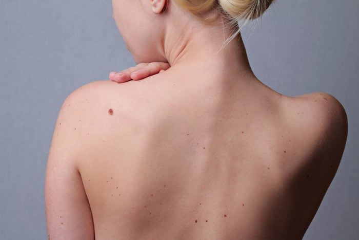 moles on woman's bare back