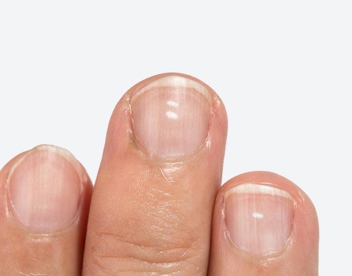 White spots on fingernails