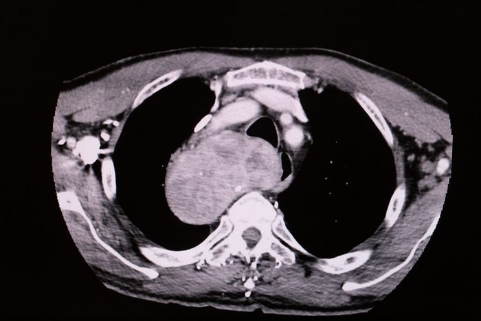 Transverse/axial plain of CT scan shows extremely enlarged thyroid gland protrude into mediastinum compresses trachea, esophagus and aorta found in an old male patient comes with breathing difficulty