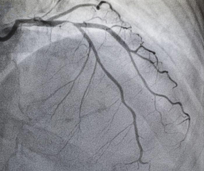Coronary angiography , left coronary angiography, stenosis at proximal Left Anterior Descending coronary artery