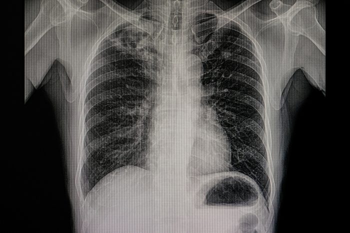 xray film of a patient with active pulmonary tuberculosis with cavitation in the right upper lung 